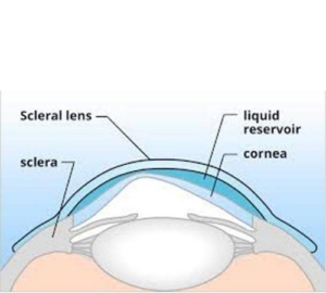 Scleralenzen